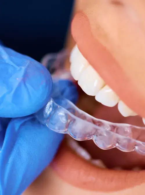 Alinhador Invisalign sendo posicionado